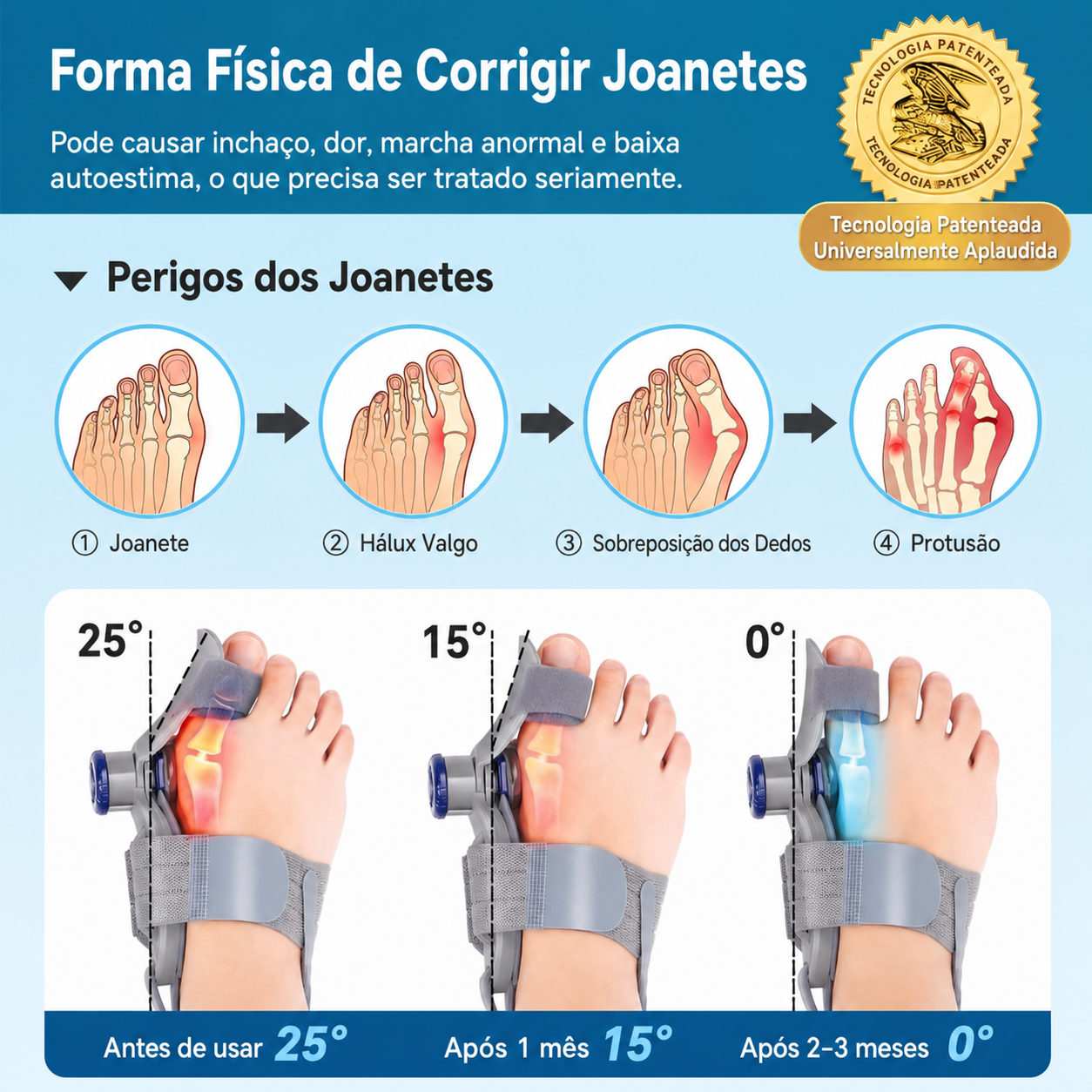 Corretor Ortopédico para joanete - Resultado em 2 semanas