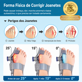 Corretor Ortopédico para joanete - Resultado em 2 semanas